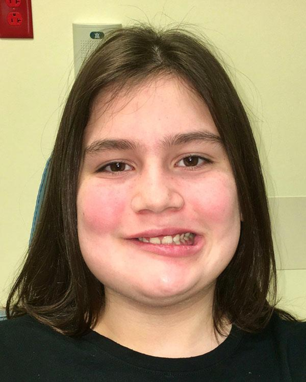 Photo of Grace Moss before surgery to remove her ameloblastoma, a benign, but aggressive, localized tumor on her lower right jaw. (Photo courtesy of UTHealth) Photo of Grace Moss before surgery to remove her ameloblastoma, a benign, but aggressive, localized tumor on her lower right jaw. (Photo courtesy of UTHealth)
